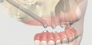 Implantes zigomáticos