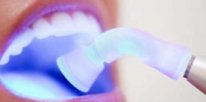 Clareamento dental a laser