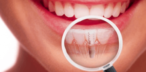 Técnicas avançadas em implantodontia